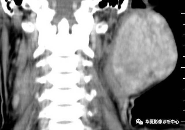 腮腺混合瘤--ct病例图片影像诊断分析