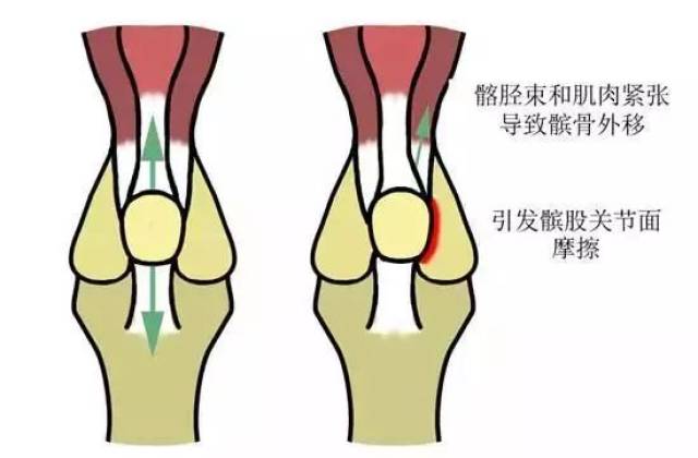 我想健康跑步一辈子:怎样跑步才能防止关节软骨磨损