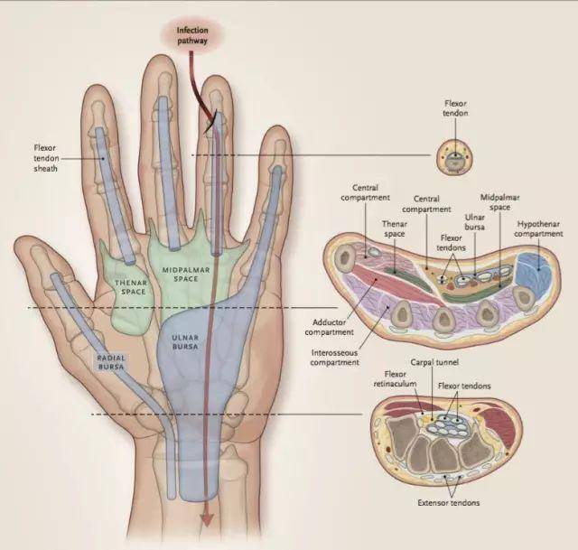 无名指的屈肌腱鞘是从屈深肌腱到掌弓延伸出去,但感染可沿着肌腱延伸