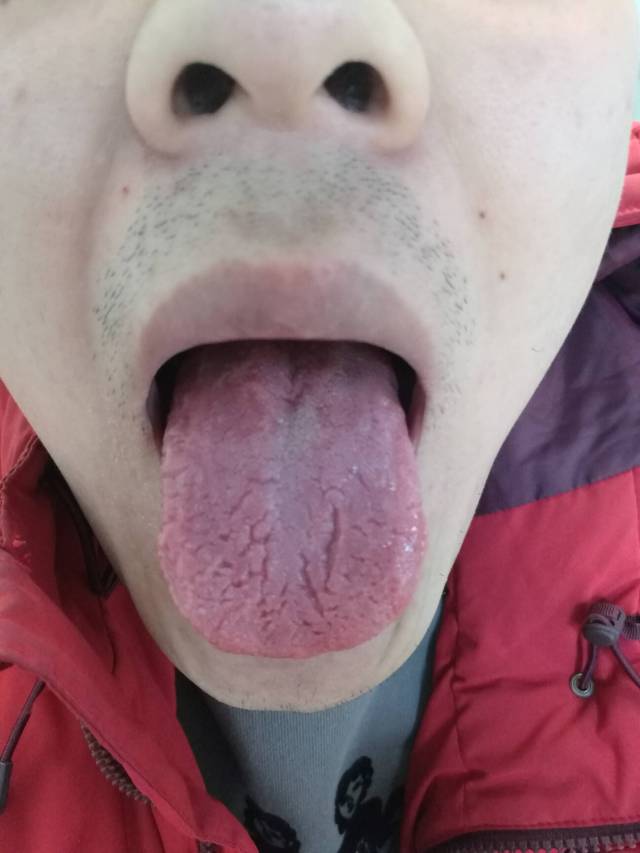 舌尖的部位全都是因为火旺后把舌头烧干裂了。购探险者享寻游大礼包广告