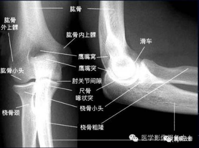 2,"八字征"是小儿髁上骨折常见征象,但在实践中,桡骨小头骨折出现此