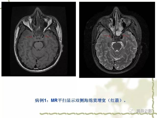 海绵窦解剖和12种常见疾病影像诊断