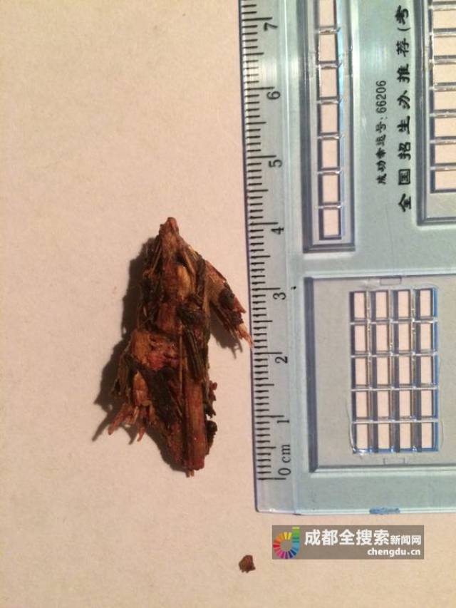 成都3岁幼儿摔跤脸上插入朽木 医生手术精准“扫雷”