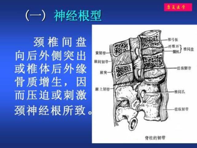 运用中医针灸,刮痧,推拿按摩治疗神经根型颈椎病的诊疗方法