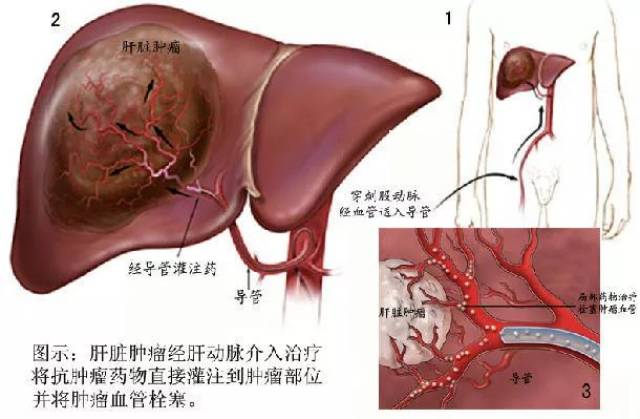 【医文医话】微创|肝动脉化疗栓塞术(tace)为中晚期肝癌患者带来福音