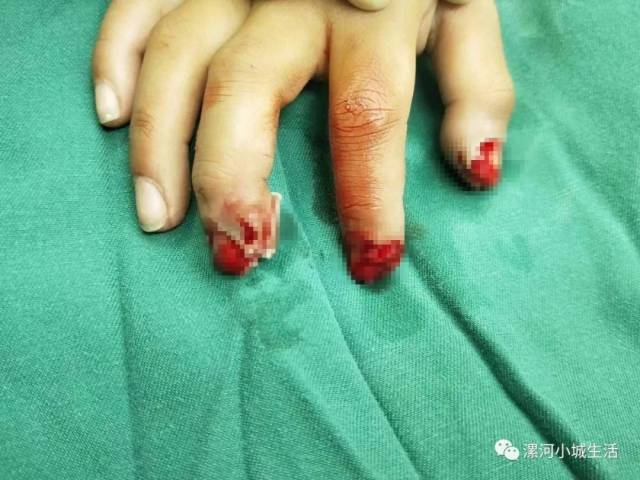 舞阳县九街镇10岁小男孩小明(化名),在燃放鞭炮时,不慎被炸伤3个手指