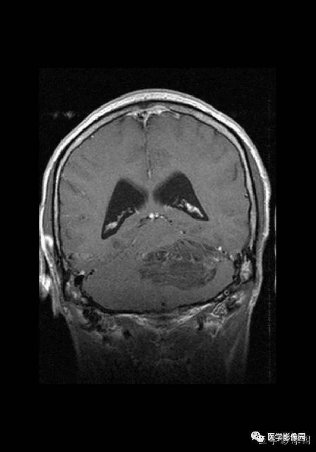 少见!又一例小脑肿瘤的mr特征表现,等你分析丨读片专栏700期