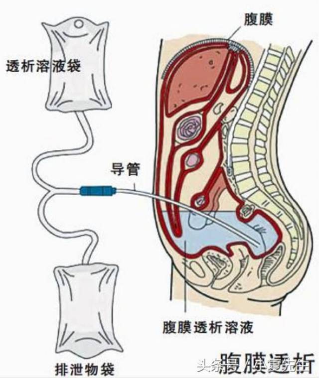 腹膜透析治疗的时候,通过腹膜透析导管将腹膜透析液灌进腹腔.