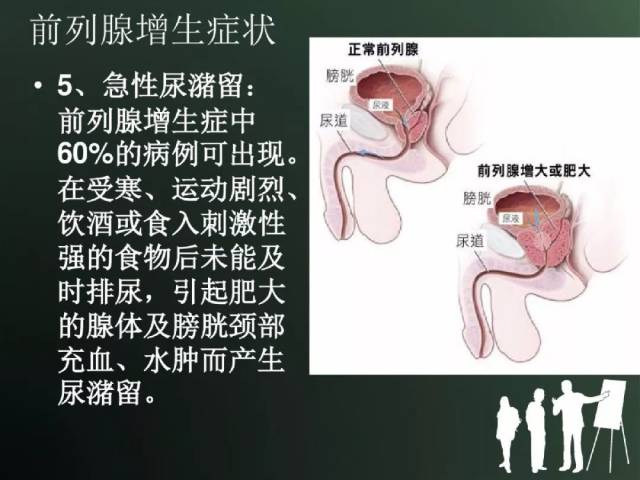 经尿道前列腺电切术后的护理