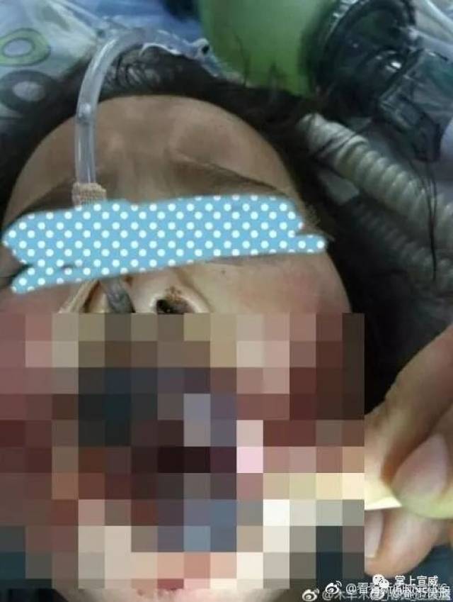 6岁女童遭父亲暴打,脱掉裤子用铁衣架打屁股