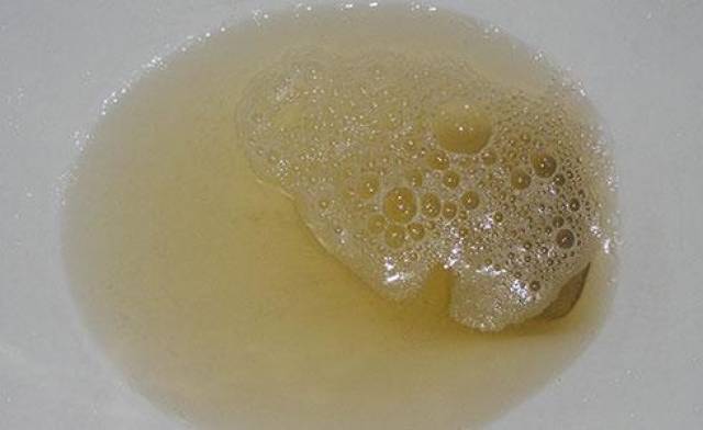 又名泡沫尿,因为肾小球屏障通透性增加,导致大分子蛋白漏出,流失在尿