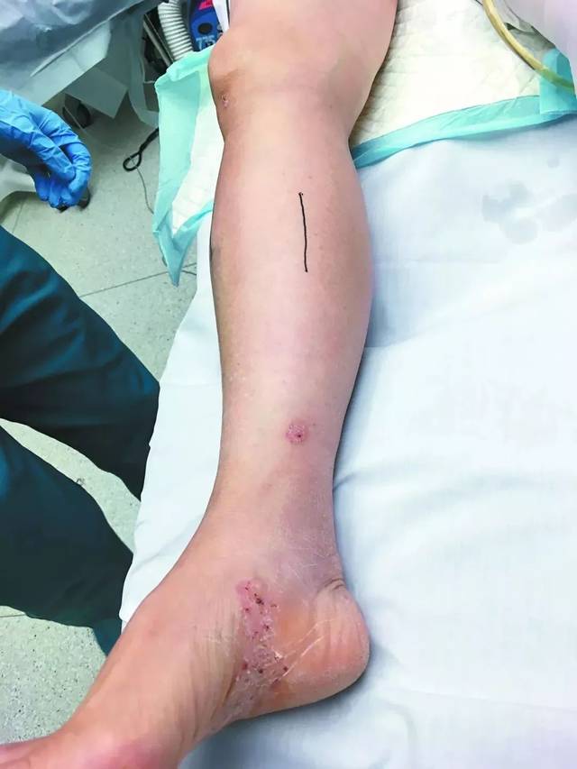 腿痒抓破后,加拿大华人老太太差点被截肢!这些事情千万不能做!