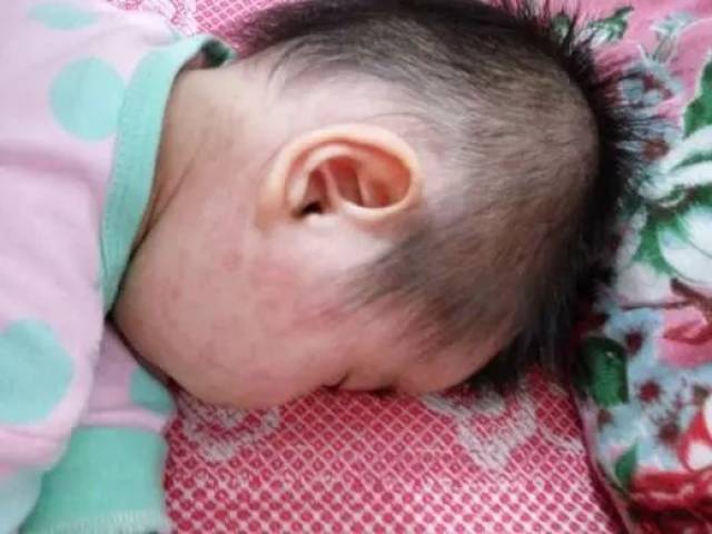 判断是否为幼儿急疹,看这三大症状就好!