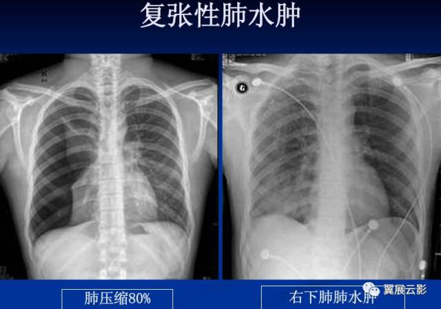 不同类型肺水肿的ct表现,你都知道吗?