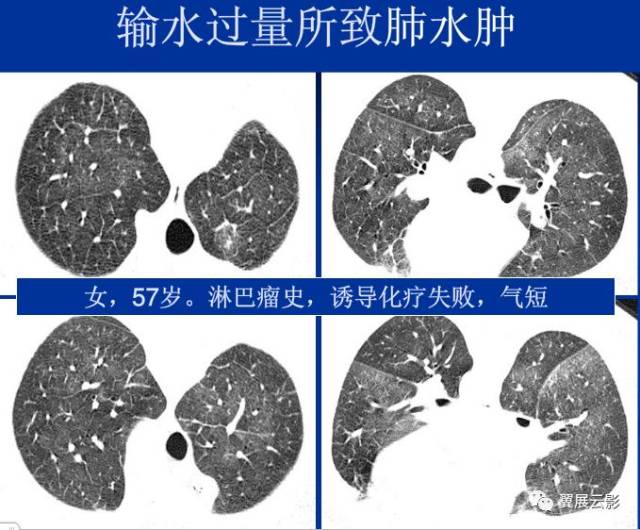 不同类型肺水肿的ct表现,你都知道吗?