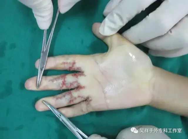 1:男 1岁 左手烫伤后左拇示指瘢痕挛缩;行瘢痕切除,松解,游离植皮术术