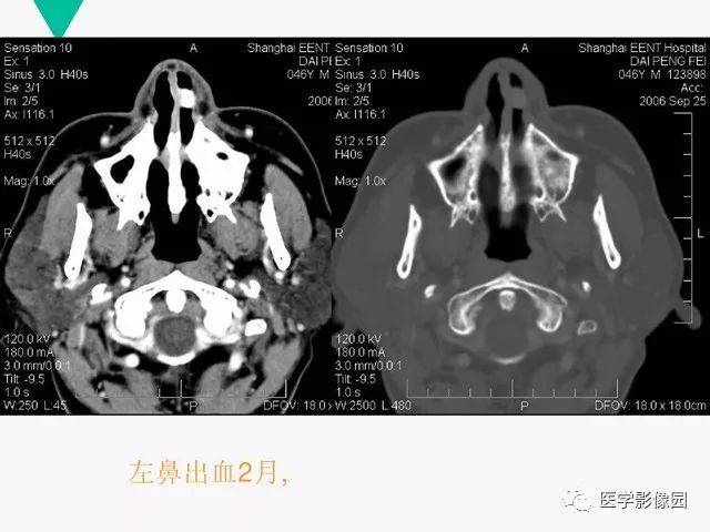 有图有笔记之鼻腔副鼻窦常见病变影像诊断丨影像天地