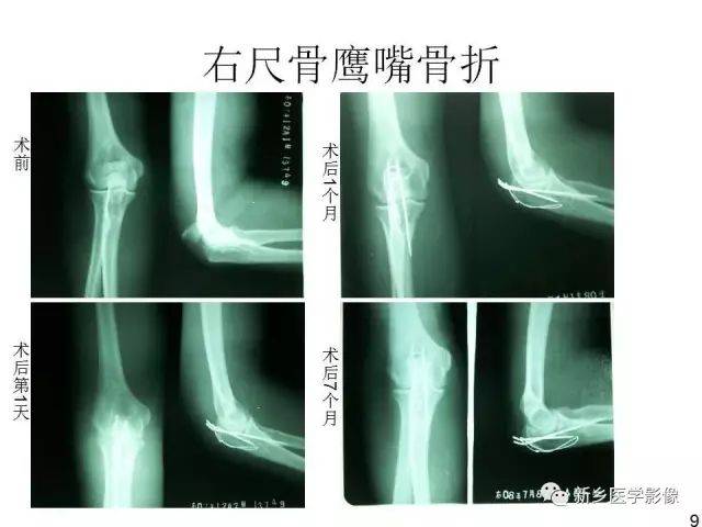 腕关节脱位及x线阅片技巧