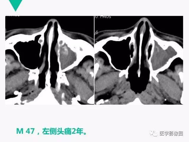 有图有笔记之鼻腔副鼻窦常见病变影像诊断丨影像天地