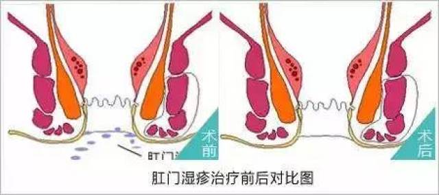 肛门湿疹会导致破皮吗?它的症状有哪些?