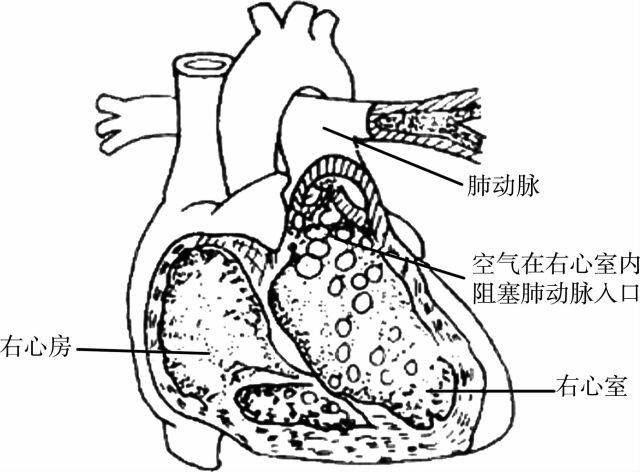 空气在右心室内阻塞肺动脉入口