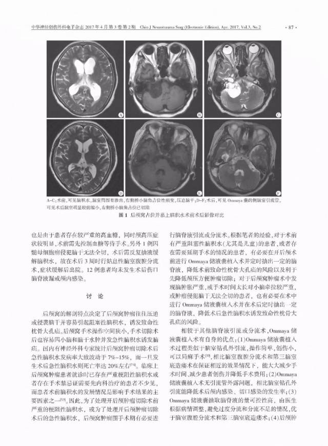 好文共赏 | 后颅窝肿瘤并阻塞性脑积水围手术期ommaya储液囊植入术