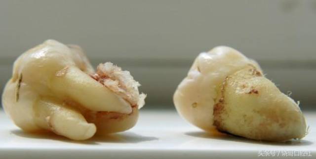 智齿位置为什么是臭的?