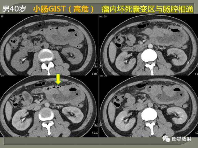 专题丨原发性胃肠道淋巴瘤的影像诊断及鉴别诊断