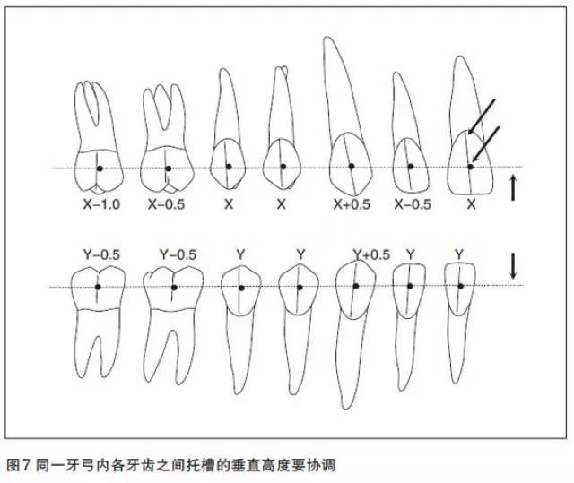 可以参考mbt滑动直丝弓矫治技术粘接托槽的相关数据,借助托槽定位器