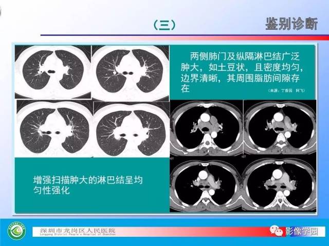 向子云主任—《小细胞肺癌的ct诊断和鉴别诊断》