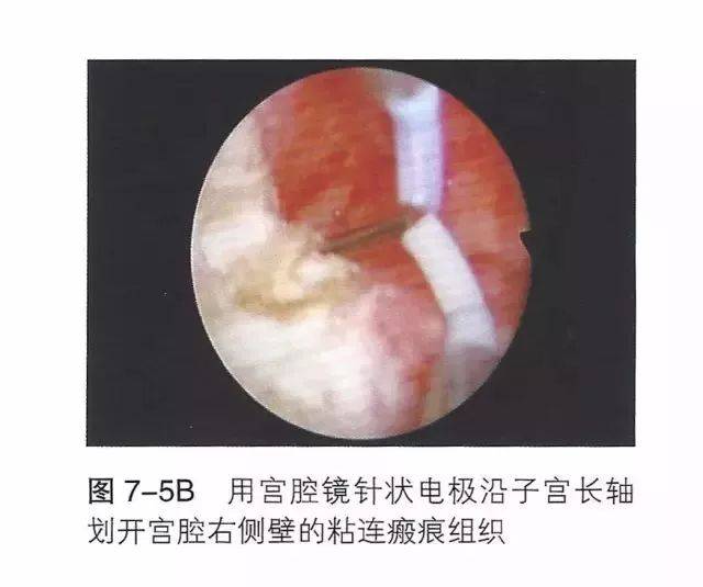 【干货】宫腔粘连宫腔镜的手术步骤