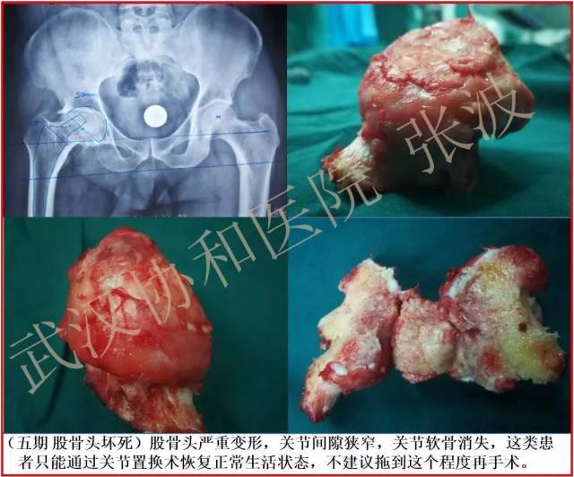 四期,五期和六期的患者,由于股骨头坏死已经导致股骨头塌陷变形,所以