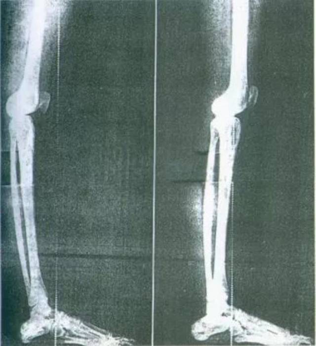 为什么你小腿这么粗?别忽视这个关键原因