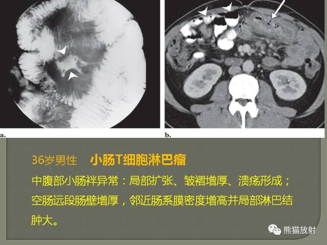 专题丨原发性胃肠道淋巴瘤的影像诊断及鉴别诊断