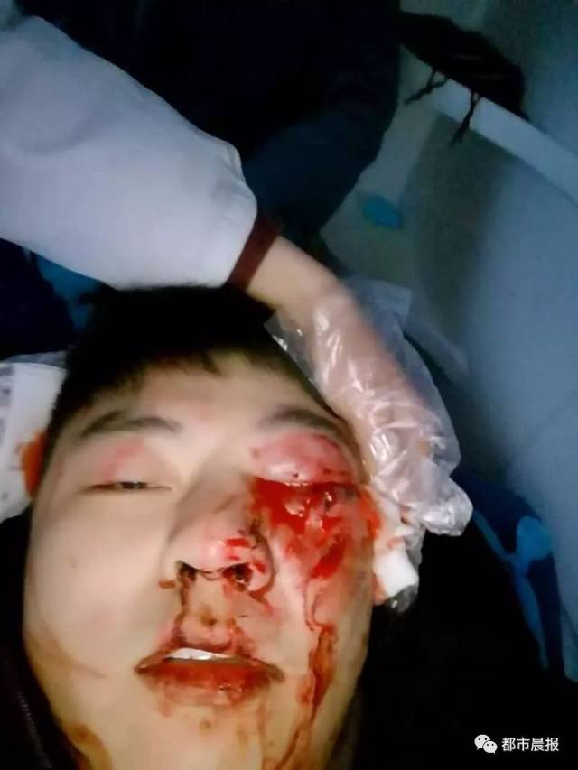 导致他的右眼被炸伤,右侧鼻骨骨折.