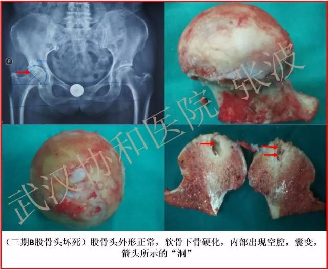 磁共振出现异常,x线片显示软骨下塌陷(新月征,股骨头内出现空洞,股