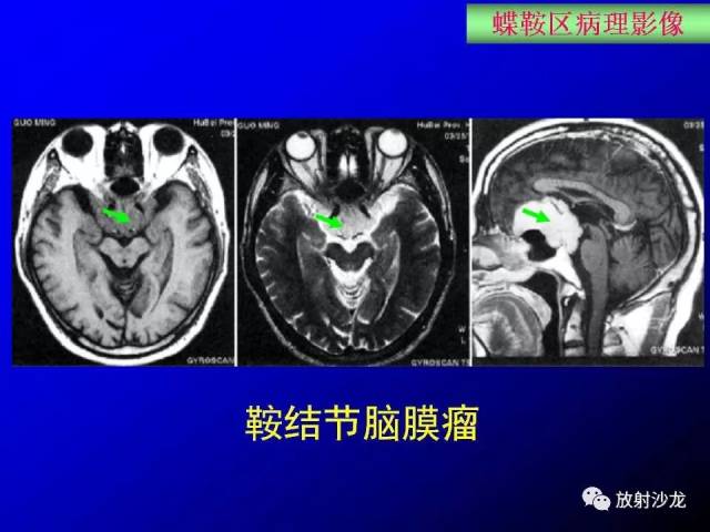 蝶鞍区解剖及疾病的影像解剖