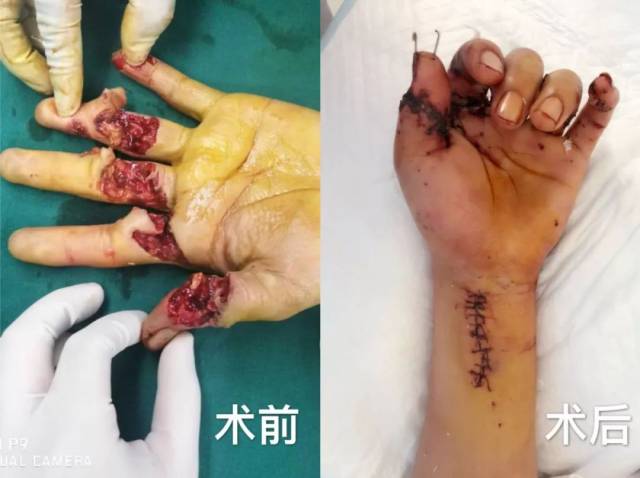 手术台上青年医生奋战12个小时,他的多根断指成功接活