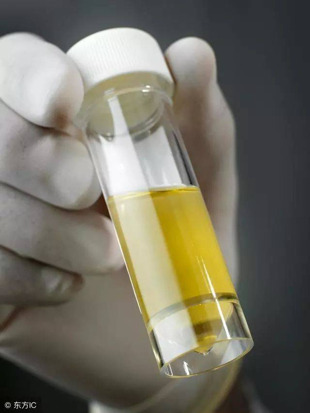 正常的尿液颜色为透明的 淡黄色,如果颜色比淡黄色稍深或是略浅,大多