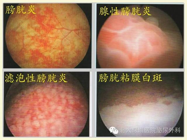 情形一:b超,ct等影像学检查发现膀胱内占位,或膀胱镜检过程中发现有