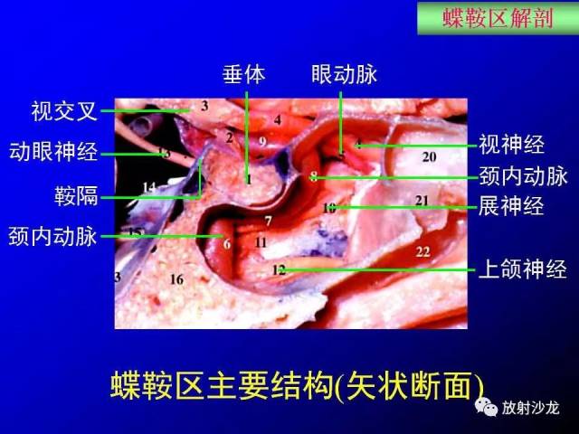 蝶鞍区解剖及疾病的影像解剖