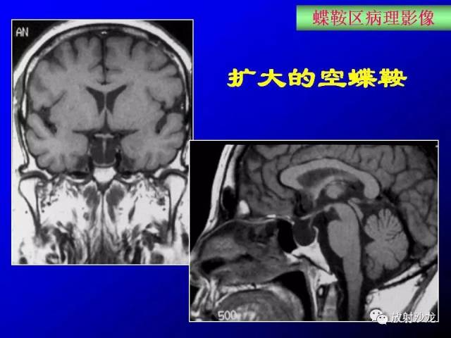 蝶鞍区解剖及疾病的影像解剖