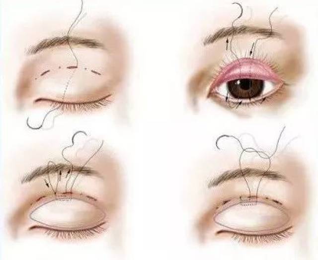 我的双眼皮埋线手术全过程，谢谢它让我变好看!