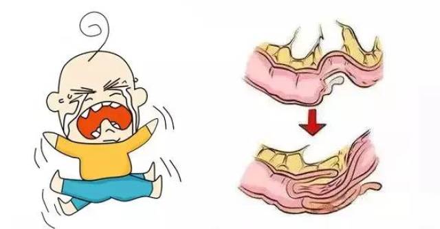 宝宝哭闹不止,还拉这样的便便,要警惕危险的"肠套叠"!