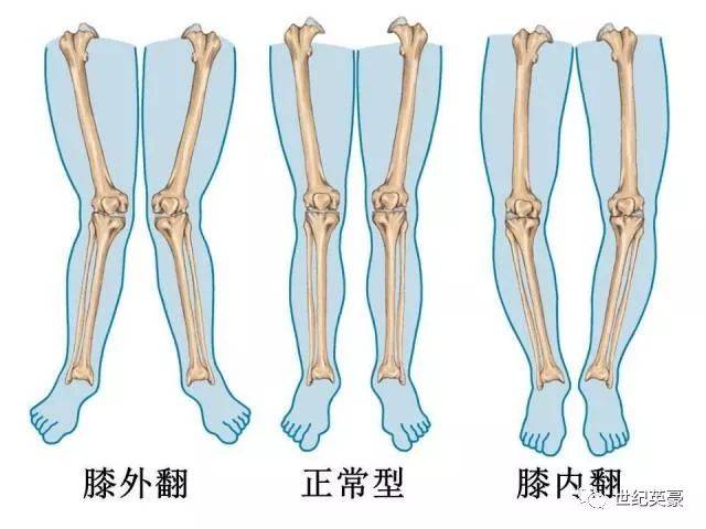 o型腿看过来这里有一份矫正指南