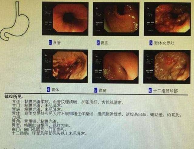 经研究表明年轻人也可能是胃癌晚期