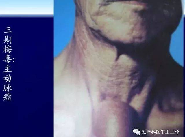 梅毒的典型症状和预防