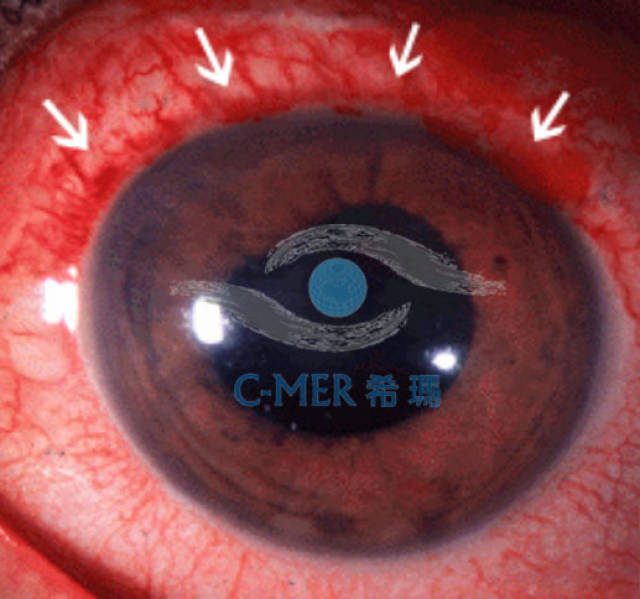 并不是所有的"红眼症"都有传染性,眼科医生教你怎样辨别