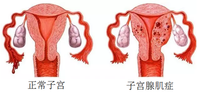 子宫肌瘤有个"闺蜜",叫做子宫腺肌症,两个要区分清
