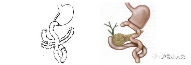 图文详解:胃癌3大类切除术及吻合手段选择